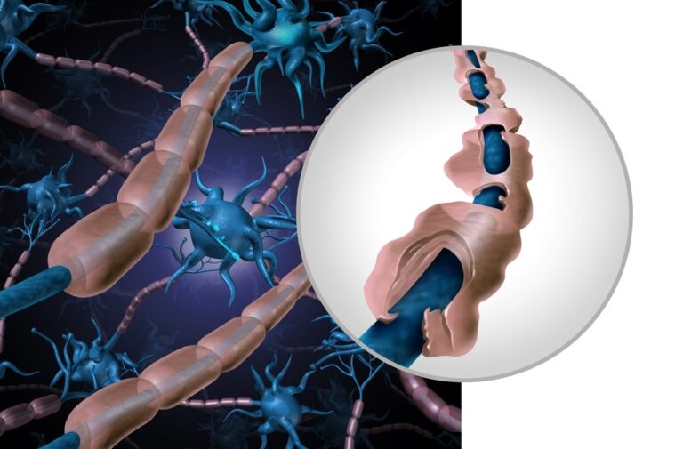 graphic illustration of multiple sclerosis (MS)