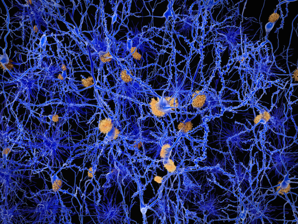 neuron network with amyloid plaques, Alzheimers disease depiction